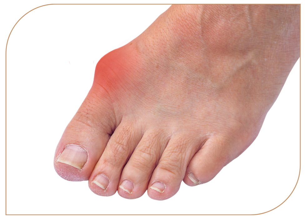 Rød og hoven kul ved stortåen som kan skyldes Hallux Valgus eller annen leddbetennelse