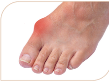Såler ved Hallux Valgus – skjev stortå og belastning i forfoten i Bergen