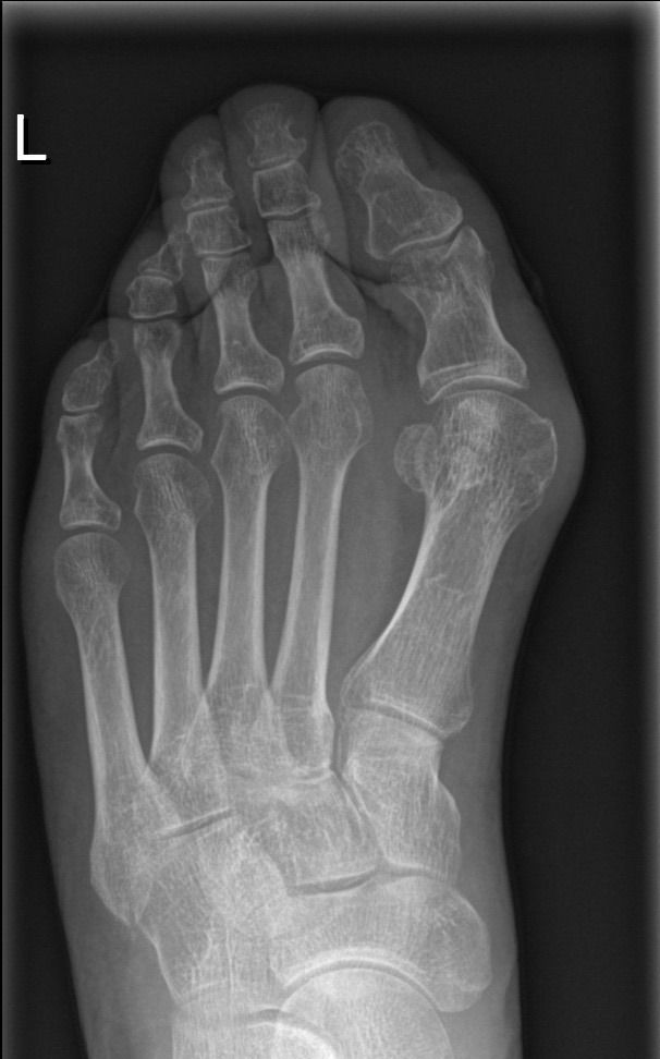 Medisinsk illustrasjon av Hallux Valgus og belastning i forfoten
