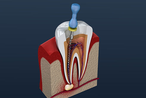 root canal treatment