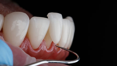 dental porcelain