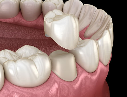 dental crown