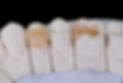 dental onlay