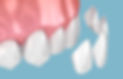 dental veneers