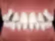3D digital rendering of impacted canines and misaligned teeth, showing how they remain trapped beneath the gums.