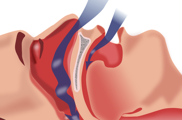 Acupuncture therapy is effective for moderate and severe obstructive sleep apnea