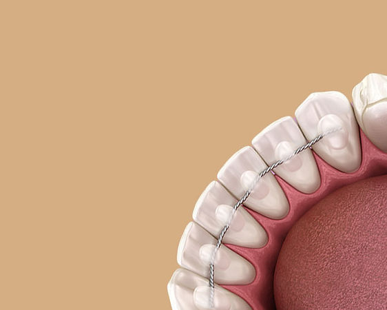 Fixed Retainers Batemans Bay Orthodontics - Orthodonist Batemans Bay
