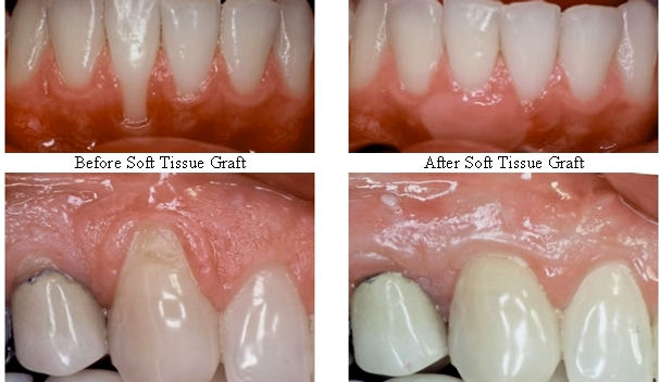 Tissue Graft | Modern Dentistry | Canberra Dentist