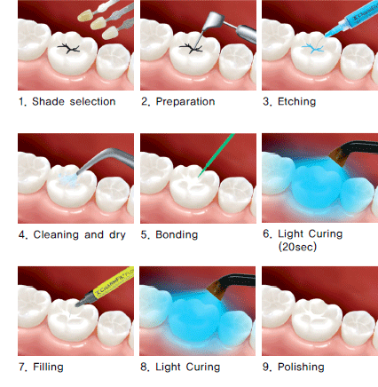 Stages of Sealant treatment | Modern Dentistry | Dentist Canberra CBD