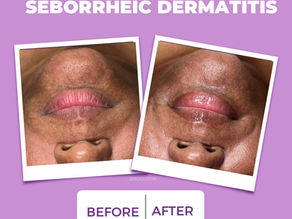 Understanding Seborrheic Dermatitis: Symptoms, Causes, and Effective Home Treatments