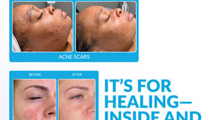 BijouSkin Facial Studio Introduces Procell Microchanneling to Deliver Advanced Skin Rejuvenation in Atlanta