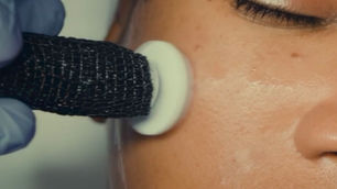 Procell Microchanneling Aftercare & Healing Time in Atlanta | Bijouskin Facial Studio