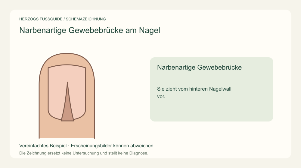 Narbenartige Gewebebrücke. Sie zieht vom hinteren Nagelwall vor. Medizinische Schemazeichnung; kein Patientenfoto.