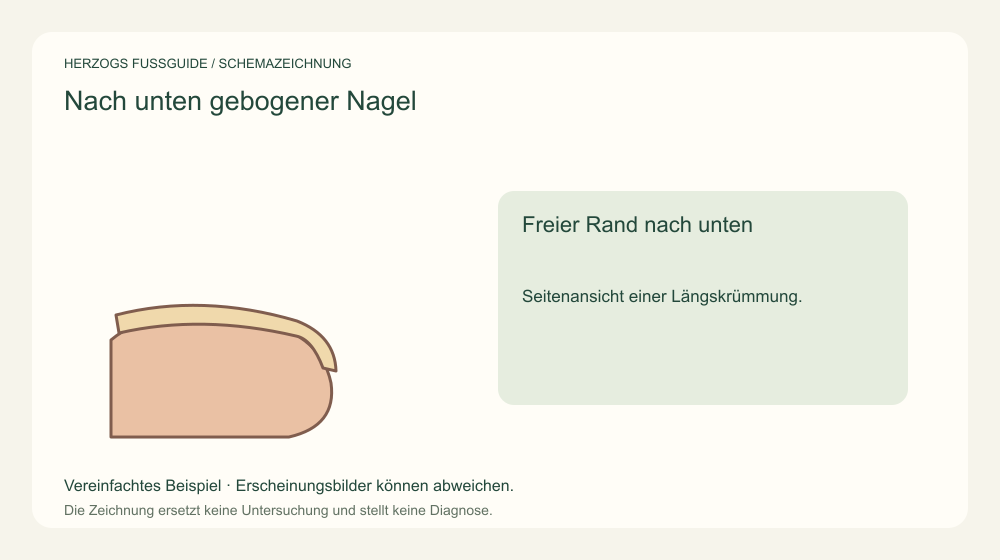 Freier Rand nach unten. Seitenansicht einer Längskrümmung. Medizinische Schemazeichnung; kein Patientenfoto.
