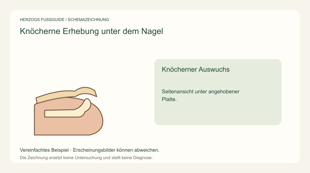 Knöcherner Auswuchs. Seitenansicht unter angehobener Platte. Medizinische Schemazeichnung; kein Patientenfoto.