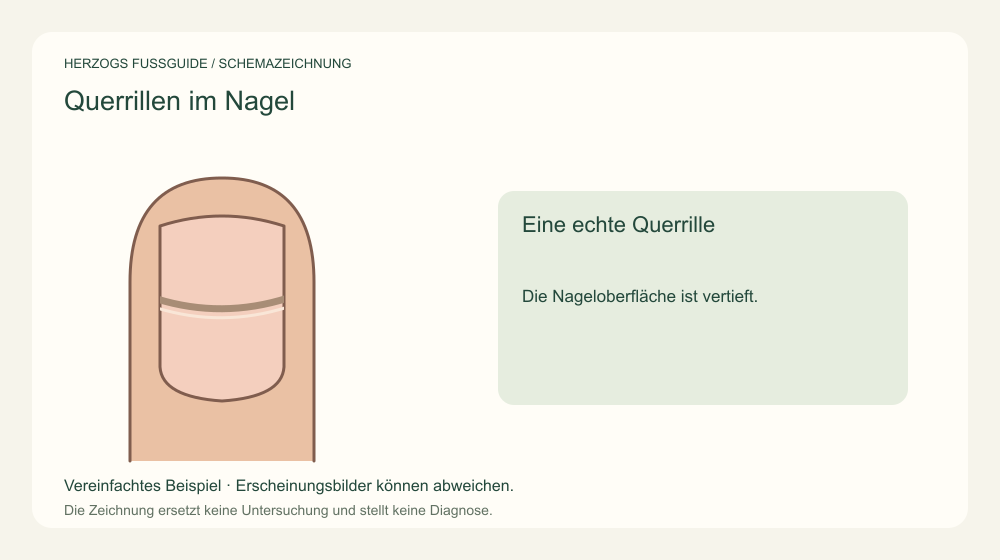 Eine echte Querrille. Die Nageloberfläche ist vertieft. Medizinische Schemazeichnung; kein Patientenfoto.
