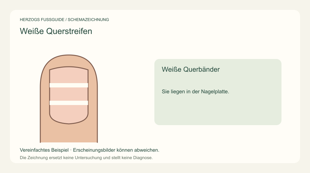 Weiße Querbänder. Sie liegen in der Nagelplatte. Medizinische Schemazeichnung; kein Patientenfoto.