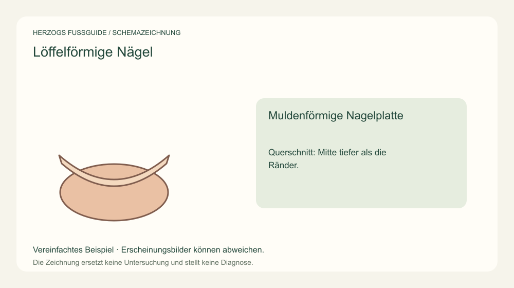 Muldenförmige Nagelplatte. Querschnitt: Mitte tiefer als die Ränder. Medizinische Schemazeichnung; kein Patientenfoto.