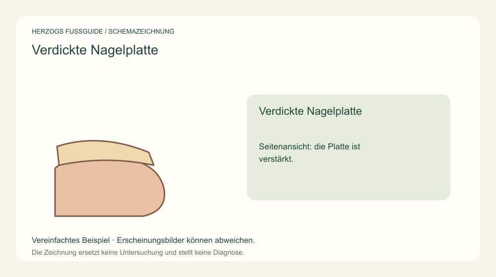 Verdickte Nagelplatte. Seitenansicht: die Platte ist verstärkt. Medizinische Schemazeichnung; kein Patientenfoto.