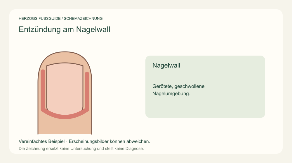Nagelwall. Gerötete, geschwollene Nagelumgebung. Medizinische Schemazeichnung; kein Patientenfoto.