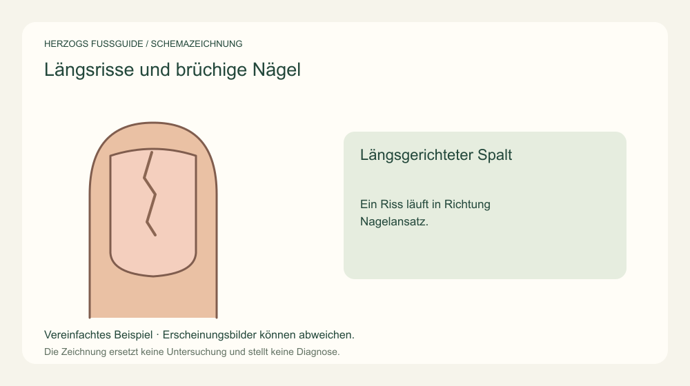 Längsgerichteter Spalt. Ein Riss läuft in Richtung Nagelansatz. Medizinische Schemazeichnung; kein Patientenfoto.