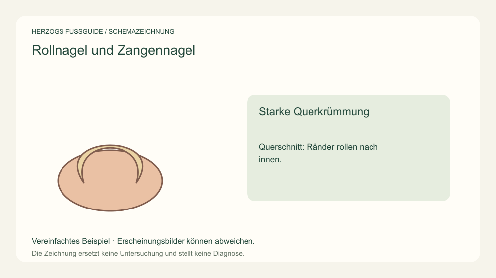 Starke Querkrümmung. Querschnitt: Ränder rollen nach innen. Medizinische Schemazeichnung; kein Patientenfoto.