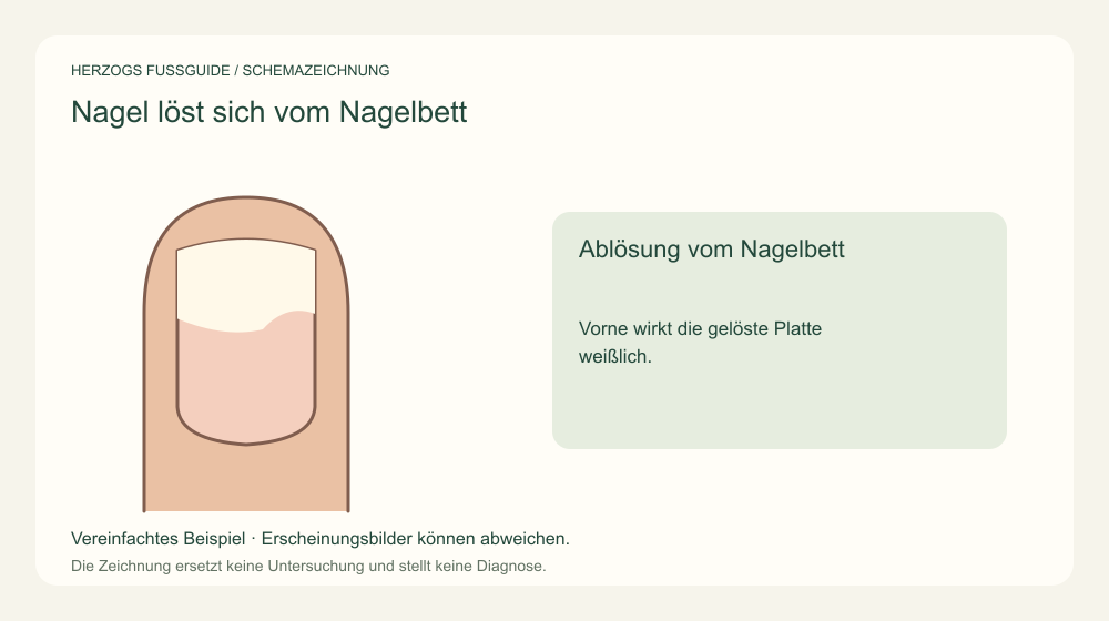 Ablösung vom Nagelbett. Vorne wirkt die gelöste Platte weißlich. Medizinische Schemazeichnung; kein Patientenfoto.