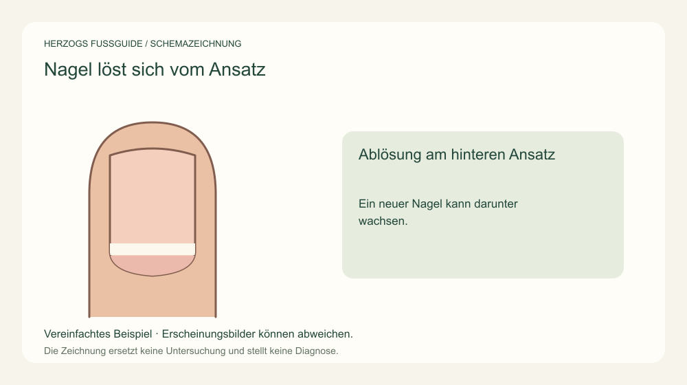 Ablösung am hinteren Ansatz. Ein neuer Nagel kann darunter wachsen. Medizinische Schemazeichnung; kein Patientenfoto.