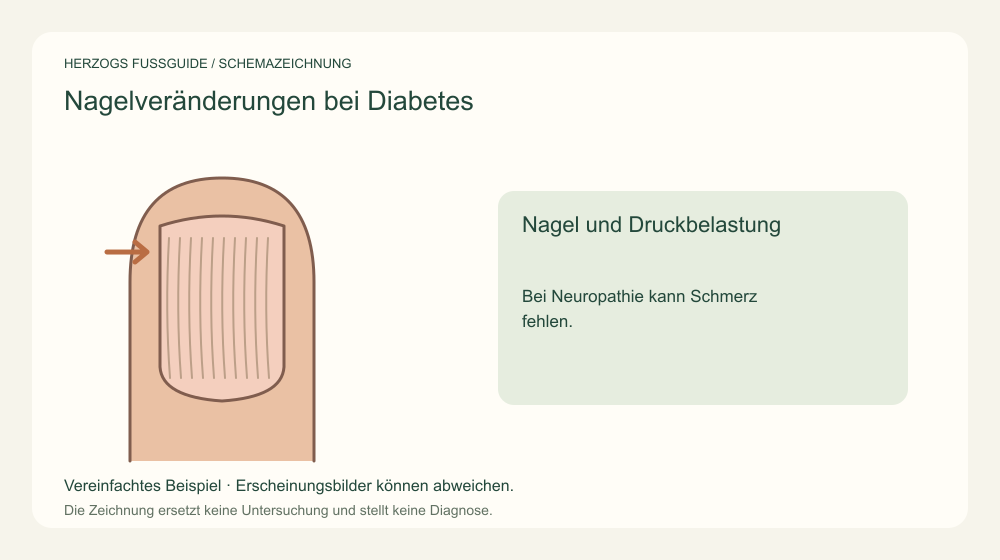 Nagel und Druckbelastung. Bei Neuropathie kann Schmerz fehlen. Medizinische Schemazeichnung; kein Patientenfoto.