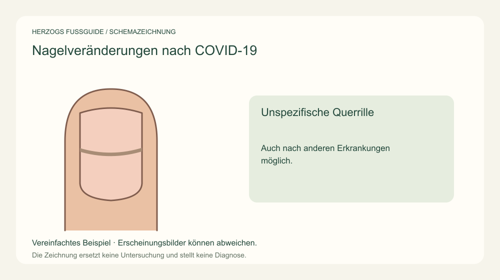Unspezifische Querrille. Auch nach anderen Erkrankungen möglich. Medizinische Schemazeichnung; kein Patientenfoto.