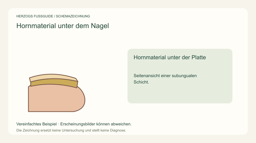 Hornmaterial unter der Platte. Seitenansicht einer subungualen Schicht. Medizinische Schemazeichnung; kein Patientenfoto.