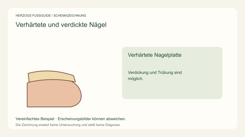 Verhärtete Nagelplatte. Verdickung und Trübung sind möglich. Medizinische Schemazeichnung; kein Patientenfoto.