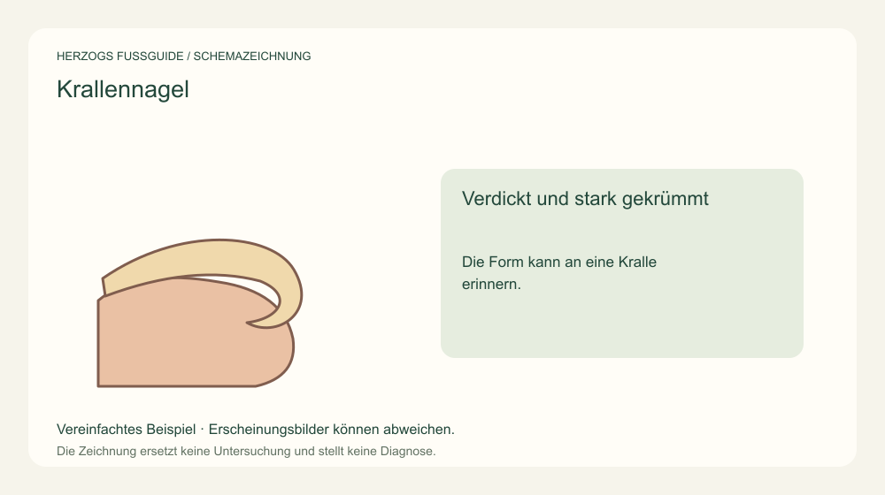 Verdickt und stark gekrümmt. Die Form kann an eine Kralle erinnern. Medizinische Schemazeichnung; kein Patientenfoto.