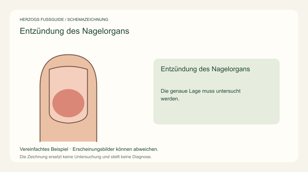 Entzündung des Nagelorgans. Die genaue Lage muss untersucht werden. Medizinische Schemazeichnung; kein Patientenfoto.