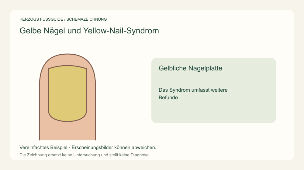 Gelbliche Nagelplatte. Das Syndrom umfasst weitere Befunde. Medizinische Schemazeichnung; kein Patientenfoto.