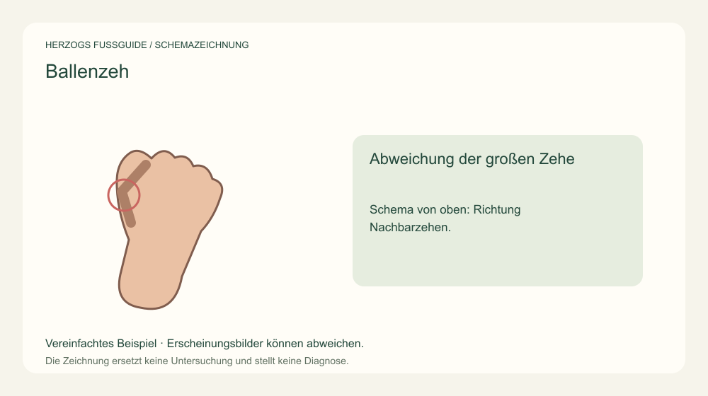 Abweichung der großen Zehe. Schema von oben: Richtung Nachbarzehen. Medizinische Schemazeichnung; kein Patientenfoto.