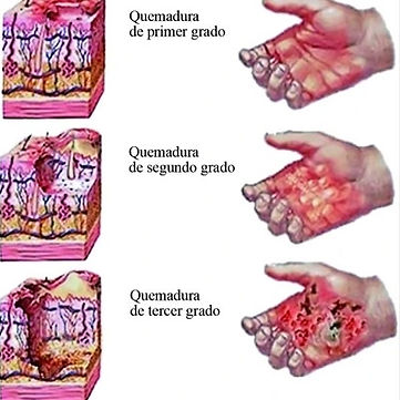 quemaduras2.jpg