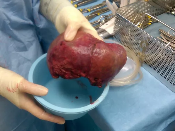 Damaged Liver after Removal