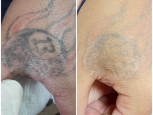Remoção de tatuagem