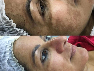 Melasma