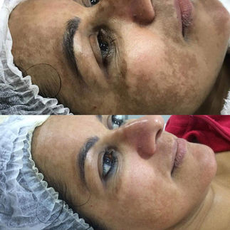 Melasma