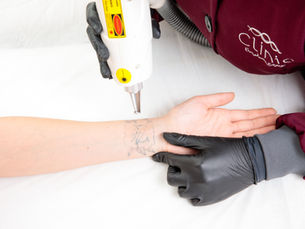 Sessão de remoção de tatuagem e micropigmentação a laser