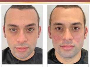 Harmonização facial masculina