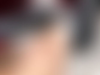 Como lidar com intercorrências no uso de preenchimento com ácido hialurônico na Harmonização facial