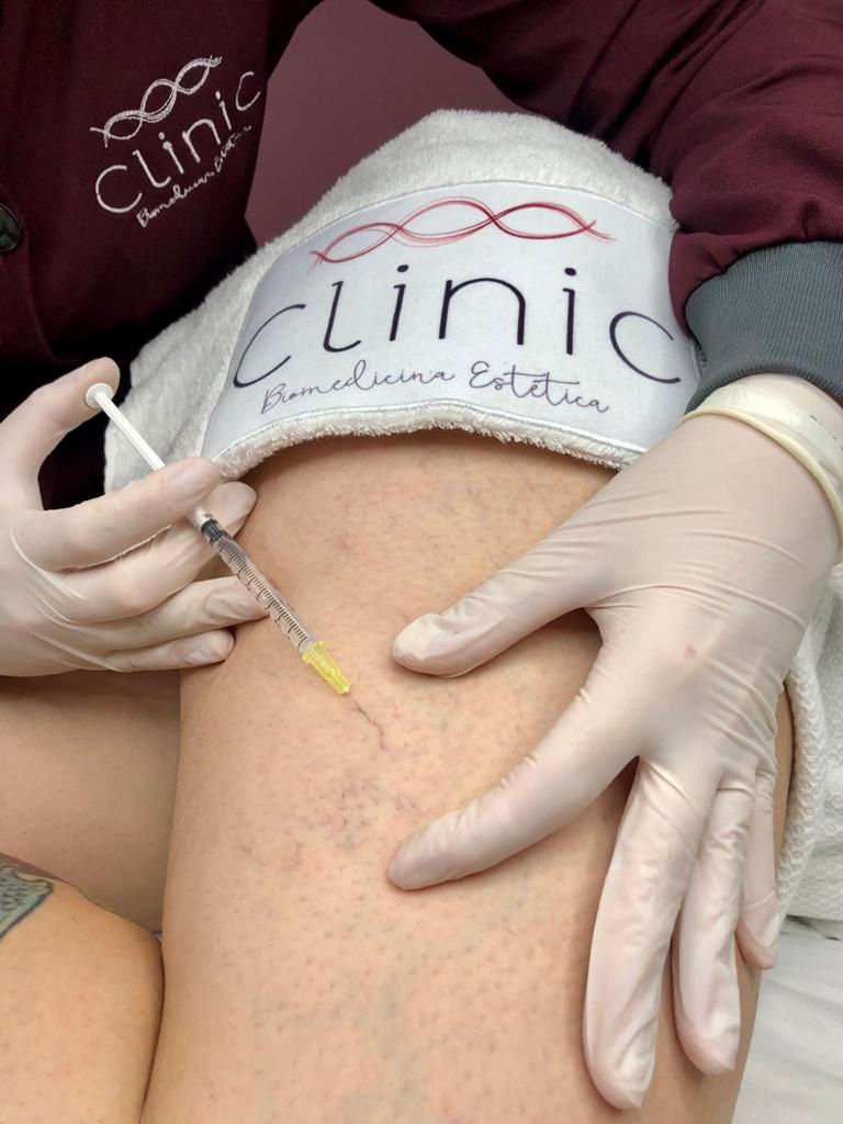Quais Profissionais Podem Realizar Escleroterapia Injetável (Secagem de Vasinhos/PEIM)?