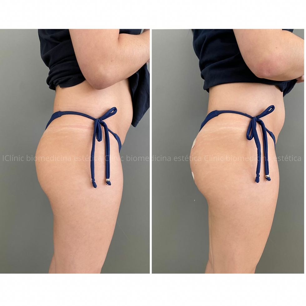 Elleva® ou Sculptra®? Qual o melhor?