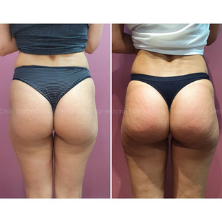 gluteo max - bumbum