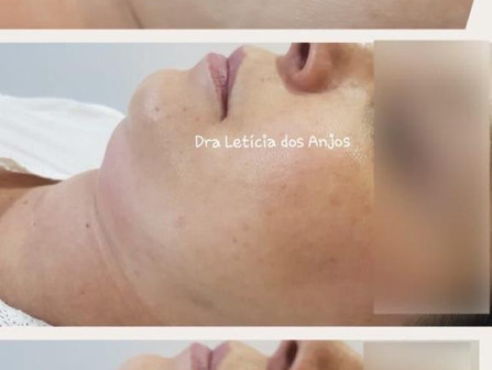 Gordura na papada? Conheça este seguro e eficaz tratamento de lipo enzimática