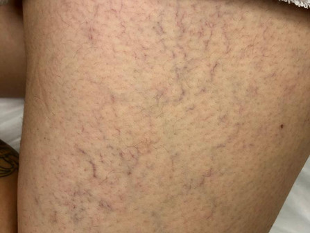 Vasinhos nas pernas: Saiba como evitar e quais tratamentos