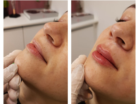 Preenchimento Labial, o “queridinho” das famosas.